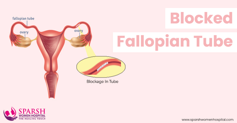 fallopian tube blockage