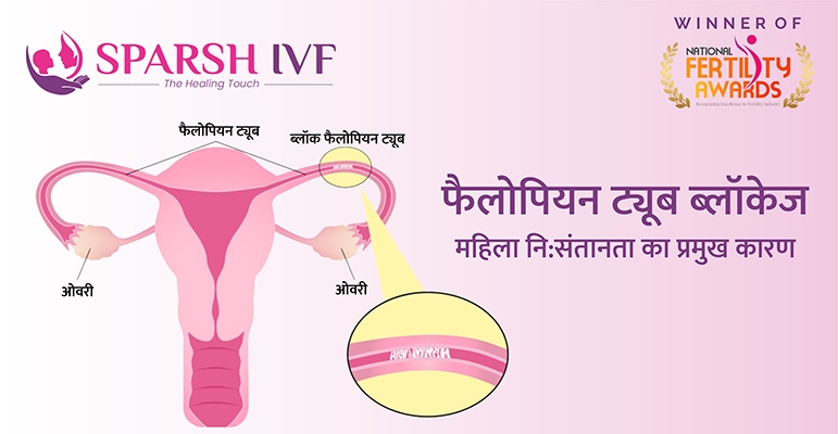 ब्लॉक फैलोपियन ट्यूब : जांच, लक्षण और उपचार ब्लॉक फैलोपियन ट्यूब, ब्लॉक फैलोपियन ट्यूब इलाज, ब्लॉक फैलोपियन ट्यूब खर्चा, ब्लॉक फैलोपियन ट्यूब लक्षण, ब्लॉक फैलोपियन ट्यूब जांच